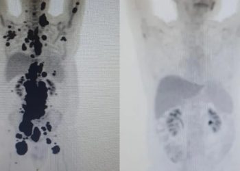 Exames mostram antes e depois de câncer de paciente; à direita, imagem mostra remissão da doença (Foto: Arquivo pessoal)