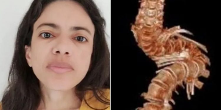 Universitária com escoliose severa precisa fazer cirurgia de R$ 1 milhão e pede ajuda