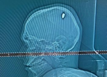 Tomografia realizada em hospital de Juiz de Fora mostra bala alojada na cabeça do estudante mineiro baleado em Cabo Frio (Foto: Arquivo Pessoal)