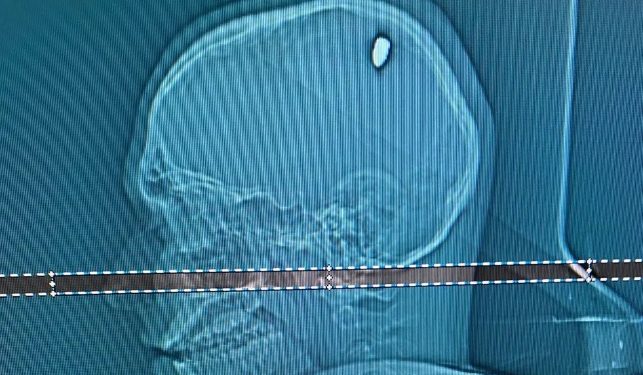 Tomografia realizada em hospital de Juiz de Fora mostra bala alojada na cabeça do estudante mineiro baleado em Cabo Frio (Foto: Arquivo Pessoal)