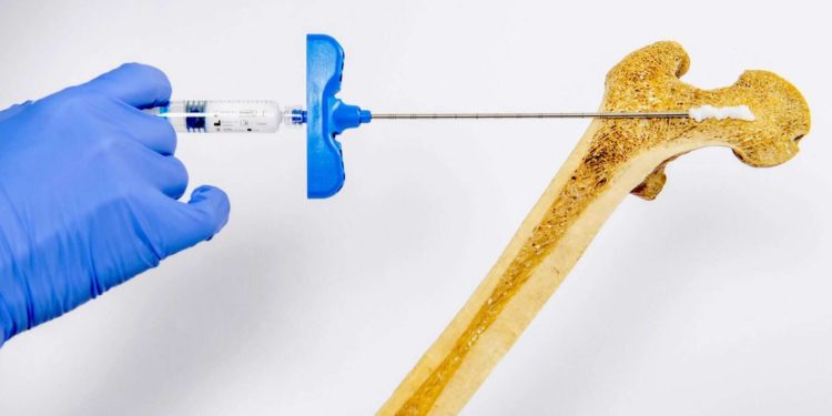 Conheça a nova técnica com “cimento injetável” que promete fortalecer ossos e acelerar tratamento da osteoporose