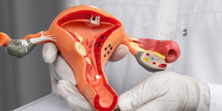 Câncer de ovário é o terceiro mais comum entre mulheres; médico dá dicas de prevenção