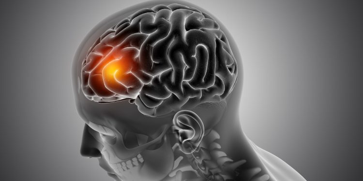 AVC mata uma pessoa a cada 6,5 minutos no Brasil e gera gastos superiores a R$ 910 milhões em cinco anos