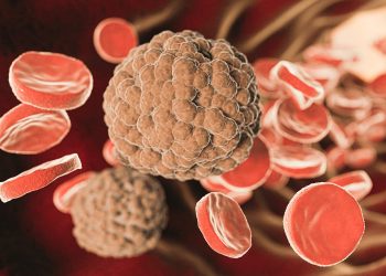 Brasil registra primeiro tratamento CAR-T totalmente produzido no país, com resultados robustos contra cânceres avançados